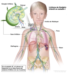 Linfoma de Hodgkin infantil en estadio I. En la imagen se observa cáncer en un grupo de ganglios linfáticos que está por encima del diafragma y en el bazo. También se muestran el anillo de Waldeyer y el timo. En la ampliación se observa un ganglio linfático con un vaso linfático, una arteria y una vena. Dentro del ganglio linfático se muestran células cancerosas.