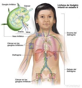 Linfoma de Hodgkin infantil en estadio II. En la imagen se observa cáncer en dos grupos de ganglios linfáticos que están por encima y debajo del diafragma. En la ampliación se observa un ganglio linfático con un vaso linfático, una arteria y una vena. Dentro del ganglio linfático se muestran células cancerosas.
