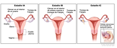 Dibujo de tres paneles de los estadios IA, IB y IC del cáncer de ovario. En el panel de la izquierda se muestra el estadio IA y se señalan las trompas de Falopio, el útero, el cuello uterino, la vagina, un ovario con cáncer en su interior y el otro ovario sano. En el panel de la mitad se muestra el estadio IB y se señalan las trompas de Falopio y los dos ovarios con cáncer en su interior. En el panel de la derecha se muestra el estadio IC y se señalan las trompas de Falopio, el ovario de la izquierda con rotura tumoral (el tumor se abrió) marcado con la letra a y el ovario de la derecha con cáncer en su superficie marcado con la letra b. En un recuadro pequeño marcado con la letra c, se observan células cancerosas en el líquido del peritoneo pélvico.