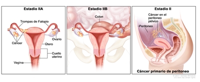 Dibujo de tres paneles del cáncer de ovario en estadios IIA y IIB y del cáncer primario de peritoneo en estadio II. En el panel de la izquierda se muestra el estadio IIA y se señalan las trompas de Falopio, el útero, el cuello uterino, la vagina y ambos ovarios con cáncer en su interior. En uno de ellos se muestra que el cáncer se diseminó hasta las trompas de Falopio y el útero. En el panel de la mitad se muestra el estadio IIB y se señala el colon. También se observan ambos ovarios con cáncer en su interior y diseminación del cáncer al colon cerca del útero. En el panel de la derecha se muestra el cáncer primario de peritoneo en estadio II y se señala el peritoneo y el cáncer en el peritoneo pélvico.