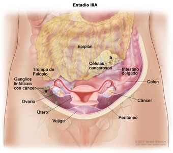 Dibujo del cáncer de ovario en estadio IIIA. Se observa el abdomen de una persona y en su interior se muestra cáncer en los ganglios linfáticos detrás del peritoneo marcados con la letra a y células cancerosas en el epiplón marcadas con la letra b. También se señalan el epiplón, el intestino delgado, el colon, una trompa de Falopio, el peritoneo, un ovario, el útero y la vejiga.