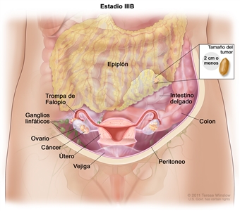 Dibujo del cáncer de ovario en estadio IIIB. Se observa el abdomen de una persona y en su interior se muestran ambos ovarios con cáncer. El cáncer se diseminó al epiplón donde el tumor mide 2 cm o menos; en un recuadro pequeño se compara el tamaño del tumor con el de un maní (cacahuete). También se señalan el epiplón, el intestino delgado, el colon, una trompa de Falopio, el peritoneo, un ovario, el útero y la vejiga.