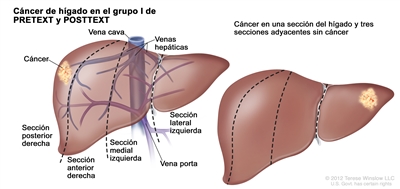 Cáncer de hígado en el grupo I de PRETEXT y POSTTEXT. En el dibujo se observan 2 hígados que se dividen con líneas punteadas en 4 secciones verticales de casi el mismo tamaño. En el hígado de la derecha se ve un área con cáncer en la sección extrema derecha. En el hígado de la izquierda se observa el área con cáncer en la sección extrema izquierda y se señala la vena cava detrás del hígado, las venas hepáticas, la vena porta, la sección posterior derecha, la sección anterior derecha, la sección medial izquierda y la sección lateral izquierda del hígado.