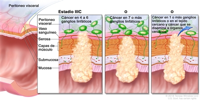 Cáncer colorrectal en estadio IIIC. En la imagen se muestran un corte transversal de la pared del colon o el recto y un recuadro de tres paneles. En cada panel se muestran las capas de la pared del colon o el recto: la mucosa, la submucosa, las capas de músculo y la serosa. También se muestran vasos sanguíneos y ganglios linfáticos. En el primer panel se observa cáncer en todas las capas, en cuatro ganglios linfáticos y en el peritoneo visceral. En el segundo panel se observa cáncer en todas las capas y en siete ganglios linfáticos. En el tercer panel se observa cáncer en todas las capas, en dos ganglios linfáticos y que se disemina a órganos cercanos.