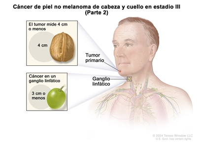 Cáncer de piel no melanoma de cabeza y cuello en estadio III (Parte 2). En el dibujo se observa una persona con un tumor primario en el mentón y cáncer en un ganglio linfático del cuello al mismo lado del cuerpo que el tumor. A la izquierda se muestran dos recuadros. En el recuadro superior, se señala que el tumor primario mide 4 cm o menos, que es casi el tamaño de una nuez. En el recuadro inferior, se señala que el cáncer en el ganglio linfático mide 3 cm o menos, que es casi el tamaño de una uva.