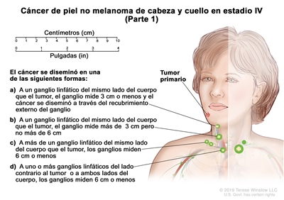 Cáncer de piel no melanoma de cabeza y cuello en estadio IV (Parte 1). En la imagen se observa un tumor primario en la cara y cáncer que se diseminó en una de las siguientes formas: a) a un ganglio linfático del mismo lado del cuerpo que el tumor, el ganglio mide 3 cm o menos y el cáncer se diseminó a través del recubrimiento externo del ganglio linfático; b) a un ganglio linfático del mismo lado del cuerpo que el tumor, el ganglio mide más de 3 cm pero no más de 6 cm; c) a más de un ganglio linfático del mismo lado del cuerpo que el tumor, los ganglios miden 6 cm o menos; y d) uno o más ganglios linfáticos del lado del cuerpo contrario al tumor o a ambos lados del cuerpo, los ganglios miden 6 cm o menos. También se observan una regla de 10 cm y una regla de 4 in.