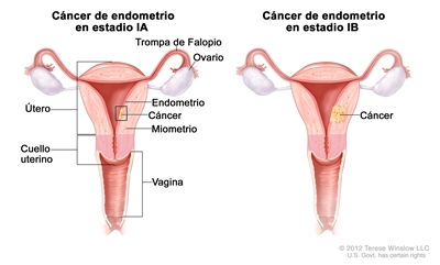Los dibujos muestran el cáncer de endometrio en estadio IA y estadio IB en dos secciones transversales del útero y el cuello uterino. El dibujo de la izquierda muestra el estadio IA con cáncer en el endometrio y el miometrio del útero. El dibujo de la derecha muestra el estadio IB con cáncer que atravesó más de la mitad del miometrio. También se muestran las trompas de Falopio, los ovarios y la vagina.