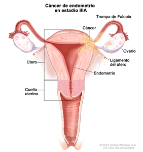 El dibujo muestra un cáncer de endometrio en estadio IIIA en una sección transversal del útero, los ligamentos del útero, el cuello uterino, las trompas de Falopio, los ovarios y la vagina. Se muestra el cáncer en el endometrio del útero, la capa exterior del útero, una trompa de Falopio, un ovario y un ligamento del útero.