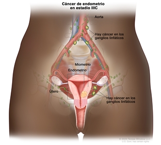 El dibujo muestra un cáncer de endometrio en estadio IIIC, en una sección transversal del útero, el cuello uterino, las trompas de Falopio, los ovarios y la vagina. También se muestran los ganglios linfáticos de la pelvis y los que están cerca de la aorta. Se muestra el cáncer en el endometrio y el miometrio del útero, y en los ganglios linfáticos de la pelvis y cerca de la aorta.