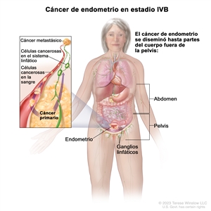 Cáncer de endometrio en estadio IVB; el dibujo muestra cáncer que se diseminó hasta partes del cuerpo afuera de la pelvis, incluso el abdomen o los ganglios linfáticos de la ingle. En el recuadro se observan células cancerosas que se diseminan desde el endometrio, a través de la sangre y el sistema linfático, a otra parte del cuerpo donde se formó el cáncer metastásico.