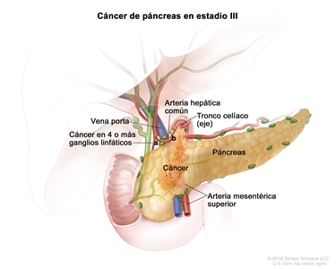 Cáncer de páncreas en estadio lll; en la imagen, se observa cáncer en el páncreas y en a) 4 o más ganglios linfáticos cercanos y b) la arteria hepática común. También se observa la vena porta, el tronco celíaco (eje) y la arteria mesentérica superior.
