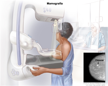 Mamografía. En el dibujo se observa una mujer que se somete a una prueba de mamografía. Ella está parada frente a una máquina de rayos X, que le presiona la mama izquierda entre dos placas a medida que crea imágenes de la mama (mamogramas). En un recuadro, se muestra una imagen radiográfica de la mama y se señala con una flecha un área circular de tejido anormal (cáncer). Detrás de la mujer, se observa una técnica que hace la prueba.