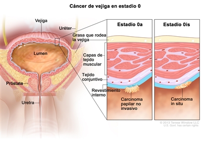 Cáncer de vejiga en estadio 0 (cáncer de vejiga no invasivo). En la imagen se muestran la vejiga, el lumen (espacio donde se almacena la orina), el uréter, la próstata y la uretra. En el recuadro de la izquierda se observa cáncer en estadio 0a (también llamado carcinoma papilar no invasivo) en el revestimiento interno de la vejiga. En el recuadro de la derecha se observa cáncer en estadio 0is (también llamado carcinoma in situ) en el revestimiento interno de la vejiga. También se muestran el tejido conjuntivo y las capas de tejido muscular de la vejiga, así como la grasa que la rodea.