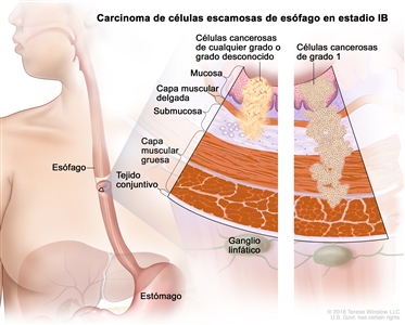 Cáncer de esófago de células escamosas en estadio IB. En la imagen se observan el esófago y el estómago. En una ampliación de dos paneles, se muestran las capas de la pared del esófago: la mucosa, la capa muscular delgada, la submucosa, la capa muscular gruesa y el tejido conjuntivo. También se muestran ganglios linfáticos. En el panel izquierdo, se observan células cancerosas de cualquier grado o de grado desconocido en la mucosa, la capa muscular delgada y la submucosa. En el panel derecho, se observan células cancerosas de grado 1 en la mucosa, la capa muscular delgada, la submucosa y la capa muscular gruesa.