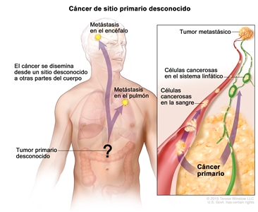 Cáncer de sitio primario desconocido. En la imagen se muestra un tumor primario que se diseminó desde un sitio desconocido a otras partes del cuerpo (el pulmón y el encéfalo). En un recuadro, se observan las células cancerosas que se diseminan desde el cáncer primario, a través de la sangre y el sistema linfático, a otra parte del cuerpo dónde se formó un tumor metastásico.