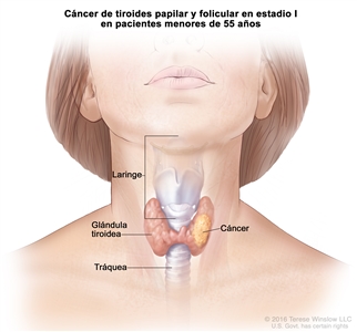 Cáncer de tiroides papilar y folicular en estadio I en pacientes menores de 55 años. En la imagen se muestra cáncer en la glándula tiroidea. También se muestran la laringe y la tráquea.