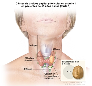 Cáncer de tiroides papilar y folicular en estadio II en pacientes de 55 años o más (Parte 1). En la imagen se muestra el cáncer en la glándula tiroidea y los ganglios linfáticos cercanos. El tumor mide 4 cm o menos. En el recuadro se observa que 4 cm es casi del tamaño de una nuez. También se muestran la laringe y la tráquea.