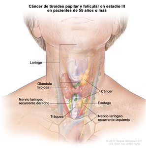 Cáncer de tiroides papilar y folicular en estadio III en pacientes de 55 años o más. En la imagen se muestra cáncer que se diseminó desde la glándula tiroidea hasta el esófago, la tráquea, la laringe y el nervio laríngeo recurrente izquierdo. También se muestra el nervio laríngeo recurrente derecho.
