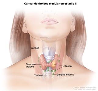 Cáncer de tiroides medular en estadio III. En la imagen se muestra cáncer en la glándula tiroidea y en los ganglios linfáticos cercanos. También se muestran la tráquea y la laringe.