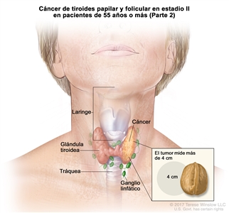 Cáncer de tiroides papilar y folicular en estadio II en pacientes de 55 años o más (Parte 2). En la imagen se muestran el cáncer en la glándula tiroidea y el tumor que mide más de 4 cm. En el recuadro se observa que 4 cm es casi del tamaño de una nuez. También se muestran los ganglios linfáticos, la laringe y la tráquea.