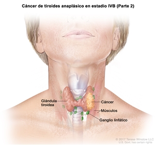 Cáncer de tiroides anaplásico en estadio IVB (Parte 2). En la imagen se muestra el cáncer en la glándula tiroidea y los músculos cercanos del cuello. También se muestran los ganglios linfáticos.