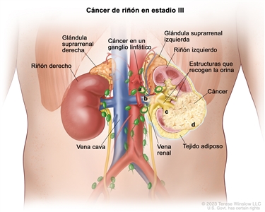 Cáncer de riñón en estadio III; en la imagen se muestra cáncer en el riñón izquierdo y en: a) los ganglios linfáticos cercanos, b) la vena renal, c) las estructuras del riñón que recogen la orina y d) la capa de tejido adiposo que rodea el riñón. También se muestra el riñón derecho, la vena cava y las glándulas suprarrenales izquierda y derecha.