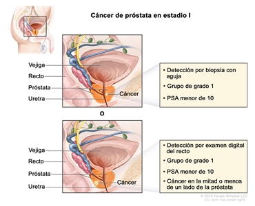 Cáncer de próstata en estadio I. Se observa una imagen con dos paneles. En el panel superior, se observa cáncer en menos de la mitad del lado derecho de la próstata que se detecta por una biopsia con aguja. En el panel inferior, se observa cáncer en menos de la mitad del lado izquierdo de la próstata que se detecta por un examen digital del recto. En ambos paneles, la concentración del PSA es menor de 10 y el grupo de grado es 1. También se muestran la vejiga, el recto y la uretra.