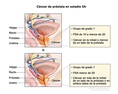 Cáncer de próstata en estadio IIA. Se observa una imagen con dos paneles. En el panel superior, se observa cáncer en la mitad o menos de un lado de la próstata. La concentración del PSA es de 10 a menos de 20 y el grupo de grado es 1. En el panel inferior, se observa cáncer en más de la mitad de un lado de la próstata. La concentración del PSA es menor de 20 y el grupo de grado es 1. En ambos paneles, también se muestran la vejiga, el recto y la uretra.