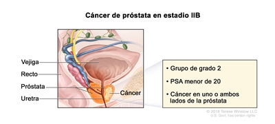 Cáncer de próstata en estadio IIB. En la imagen se observa cáncer en un lado de la próstata. La concentración del PSA es menor de 20 y el grupo de grado es 2. También se muestran la vejiga, el recto y la uretra.