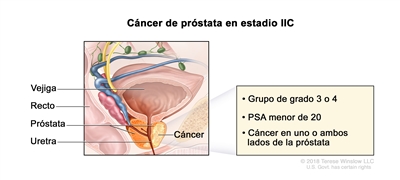 Cáncer de próstata en estadio IIC. En la imagen se observa cáncer en ambos lados de la próstata. La concentración del PSA es menor de 20 y el grupo de grado es 3 o 4. También se muestran la vejiga, el recto y la uretra.