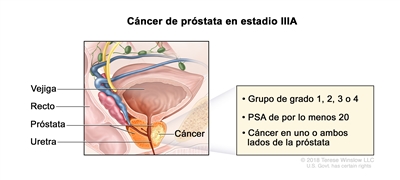 Cáncer de próstata en estadio IIIA. En la imagen se observa cáncer en un lado de la próstata. La concentración del PSA es de por lo menos 20 y el grupo de grado es 1, 2, 3 o 4. También se muestran la vejiga, el recto y la uretra.