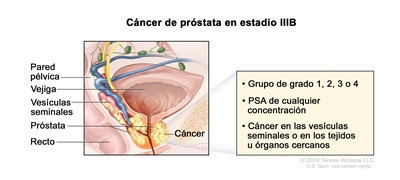 Cáncer de próstata en estadio IIIB. En la imagen se observa cáncer que se diseminó de la próstata a las vesículas seminales y al tejido cercano. El PSA es de cualquier concentración y el grupo de grado es 1, 2, 3 o 4. También se muestran la pared pélvica, la vejiga y el recto.