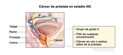 Cáncer de próstata en estadio IIIC. En la imagen se observa cáncer en un lado de la próstata. El PSA es de cualquier concentración y el grupo de grado es 5. También se muestran la vejiga, el recto y la uretra.