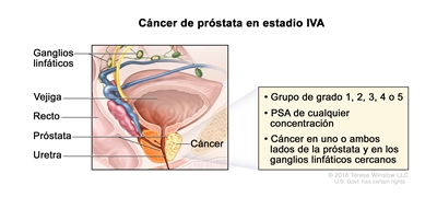 Cáncer de próstata en estadio IVA. En la imagen se observa cáncer en un lado de la próstata y en los ganglios linfáticos cercanos. El PSA es de cualquier concentración y el grupo de grado es 1 ,2, 3, 4 o 5. También se muestran la vejiga, el recto y la uretra.