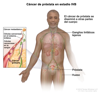 Cáncer de próstata en estadio IVB. En la imagen se observan otras partes del cuerpo donde es posible que el cáncer de próstata se haya diseminado, como los ganglios linfáticos lejanos y el hueso. En un recuadro, se muestran células cancerosas que se diseminan desde la próstata, a través de la sangre y el sistema linfático, hasta otra parte del cuerpo donde se formó el cáncer metastásico.