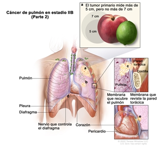Cáncer de pulmón en estadio IIB (Parte 2). En la imagen se observa lo siguiente: a) un tumor primario que mide más de 5 cm, pero no más de 7 cm en el pulmón izquierdo (recuadro superior); b) un tumor separado en el mismo lóbulo del pulmón que el tumor primario. También se observa cáncer que se diseminó a los siguientes sitios: c) la pared torácica, la membrana que recubre el pulmón y la membrana que reviste la pared torácica (recuadro intermedio); d) el nervio que controla el diafragma; e) el pericardio (recuadro inferior). Además, se muestran la pleura, el diafragma, el corazón y en el recuadro intermedio, una costilla.