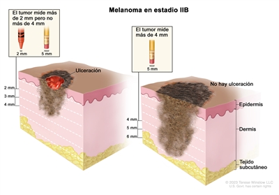 Dibujo de dos paneles del melanoma en estadio IIB. En el panel de la izquierda se observa un tumor que mide más de 2 mm pero no más 4 mm y hay ulceración (rotura de la piel). Además, hay un recuadro en el que se indica que 2 mm es aproximadamente la medida de la punta de un crayón, y 5 mm, la de la goma de borrar del extremo de un lápiz. En el panel de la derecha se observa un tumor que mide más de 4 mm y no hay ulceración. Además, hay un recuadro en el que se indica que 5 mm es aproximadamente la medida de la goma de borrar del extremo de un lápiz. También se muestran la epidermis (capa superficial o externa de la piel), la dermis (capa profunda o interna de la piel) y el tejido subcutáneo debajo de la dermis.