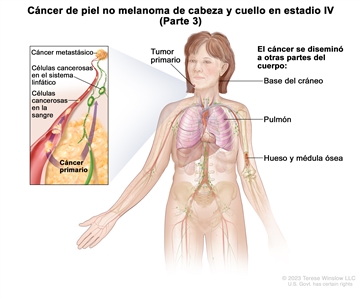 Cáncer de piel no melanoma de cabeza y cuello en estadio IV (Parte 3). En el dibujo se observa un tumor primario en la cara y otras partes del cuerpo donde es posible que el cáncer de piel no melanoma se disemine, como la base del cráneo, el pulmón, el hueso y la médula ósea. En el recuadro se muestran las células cancerosas que se diseminan a través de la sangre y el sistema linfático a otra parte del cuerpo donde se formó el cáncer metastásico.