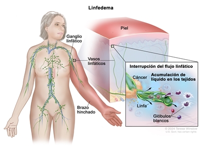 Linfedema. En el dibujo se observa una mujer con un brazo rojo e hinchado. También se señalan ganglios y vasos linfáticos en su cuerpo. Hay una ampliación del brazo hinchado en el que se observa la capa superior de la piel endurecida y roja. Además, en un recuadro se ve un vaso linfático debajo de la piel y un tumor canceroso que interrumpe el flujo de la linfa por el vaso, así como una acumulación de líquido y glóbulos blancos en los tejidos que rodean el vaso.