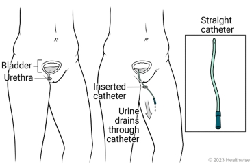 Bladder and urethra, showing catheter inserted in urethra and urine draining through catheter, with detail of straight catheter.