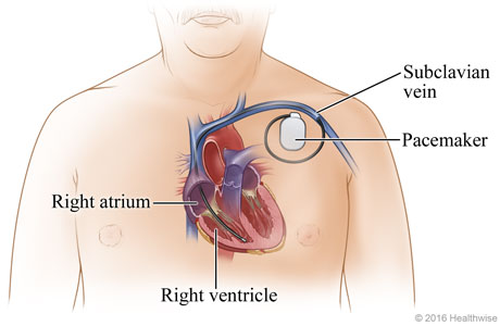 Location of pacemaker in upper-left chest, showing its lead through subclavian vein and into right ventricle