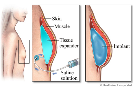 Tissue expander and breast implant after mastectomy