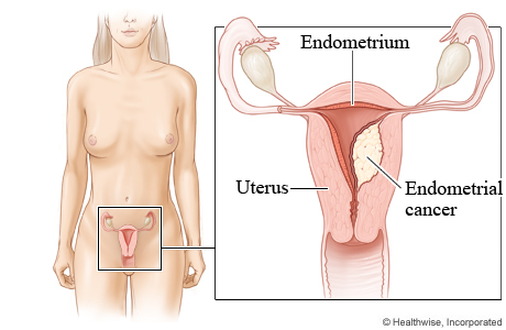 Endometrial cancer