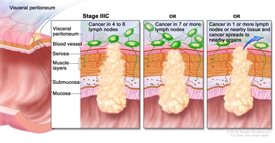 Stage IIIC colorectal cancer; drawing shows a cross-section of the colon/rectum and a three-panel inset. Each panel shows the layers of the colon/rectum wall: the mucosa, submucosa, muscle layers, and serosa. Also shown are a blood vessel and lymph nodes. The first panel shows cancer in all layers, in 4 lymph nodes, and in the visceral peritoneum. The second panel shows cancer in all layers and in 7 lymph nodes. The third panel shows cancer in all layers, in 2 lymph nodes, and spreading to nearby organs.