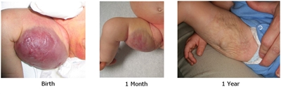 Photographs showing a cutaneous congenital hemangioma on the inner right thigh at birth (left panel), 1 month (middle panel), and 1 year (right panel).