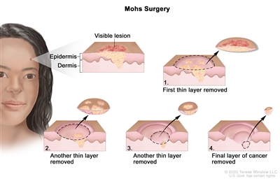 Mohs surgery; drawing shows a patient with skin cancer on the face. The pullout shows a block of skin with cancer in the epidermis (outer layer of the skin) and the dermis (inner layer of the skin). A visible lesion is shown on the skin's surface. Four numbered blocks show the removal of thin layers of the skin one at a time until all the cancer is removed.