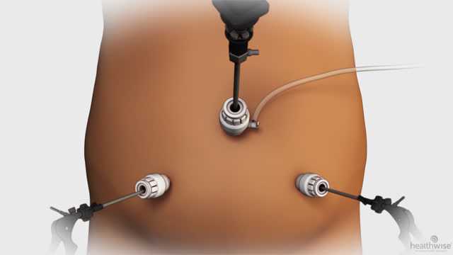 Laparoscopy