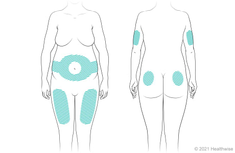 Lugares del cuerpo para administrar inyecciones de insulina