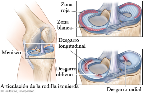 Zonas de sanación de menisco y tipos de desgarro de menisco