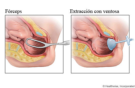 Métodos con fórceps y con extracción con ventosa para el parto asistido